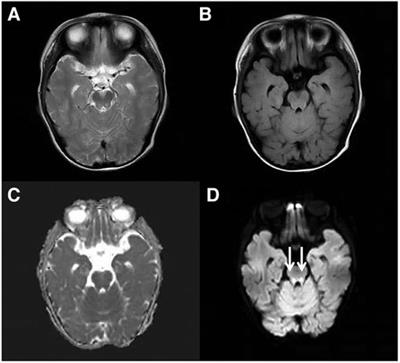 A riboflavin transporter deficiency presenting as pure red cell aplasia: a pediatric case report